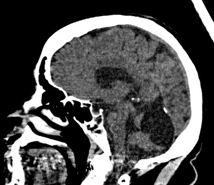 Posterior Fossa Arachnoid Cyst Image Radiopaedia Org