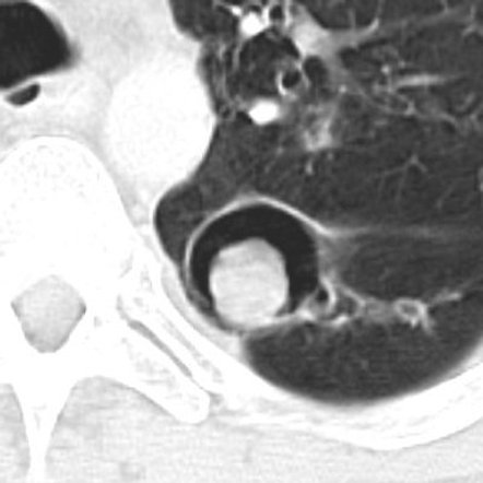 Pulmonary Aspergillosis Radiology Reference Article Radiopaedia Org