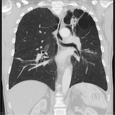 Pulmonary Aspergilloma Radiology Case Radiopaedia Org