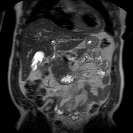 Gallbladder Polyp Radiology Reference Article Radiopaedia Org