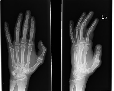 Metacarpal Fractures Radiology Case Radiopaedia Org