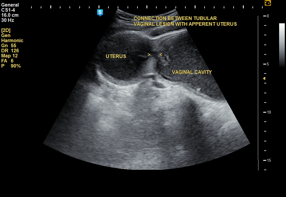 Imperforate Hymen Repair