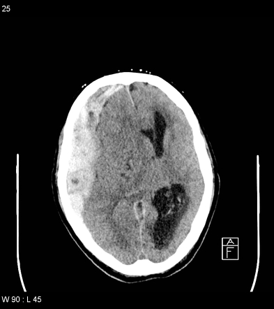 Acute Subdural Haematoma With Myelofibrosis Radiology Case