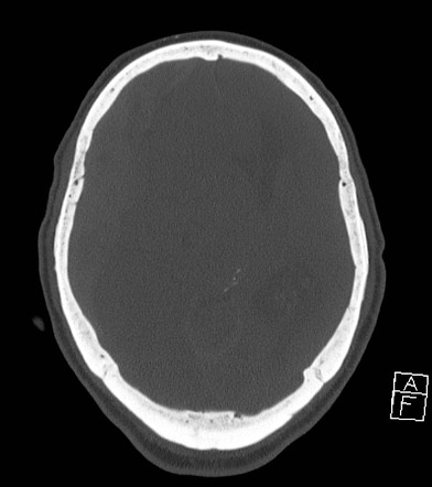 Acute Subdural Hematoma With Myelofibrosis Image Radiopaedia Org