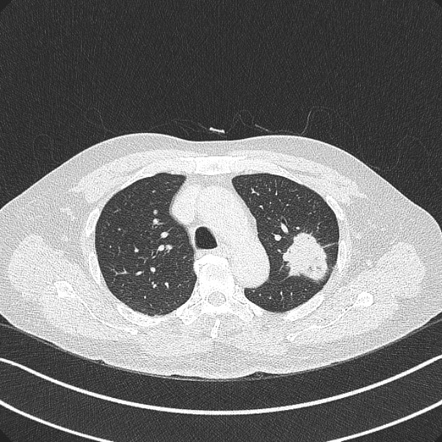 T A Lung Cancer Radiology Case Radiopaedia Org