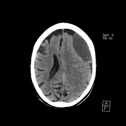 Acute On Chronic Subdural Haematoma Radiology Case Radiopaedia Org