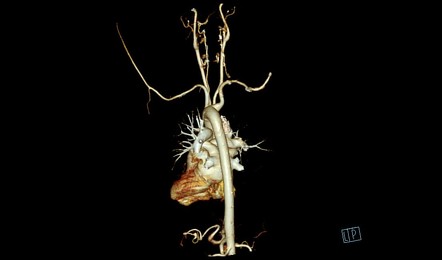 Aberrant Right Subclavian Artery Image Radiopaedia Org