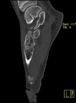 Chronic Osteomyelitis Radiology Case Radiopaedia Org