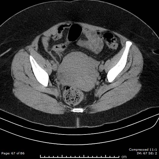 Epiploic Appendagitis Image Radiopaedia Org