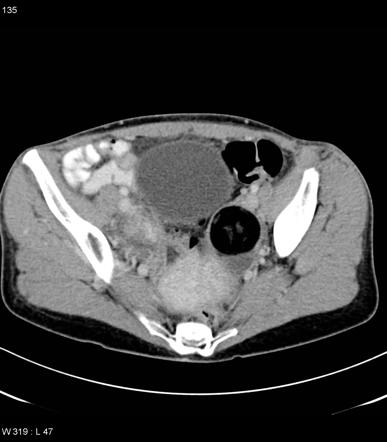 Mature Cystic Ovarian Teratoma Radiology Reference Article