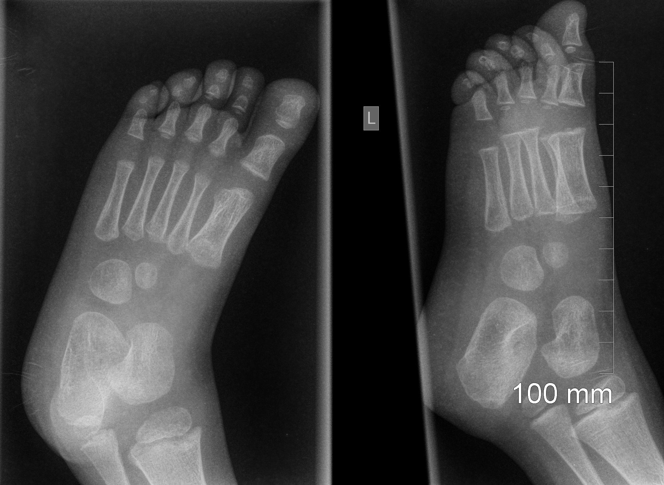 Right Foot X Ray