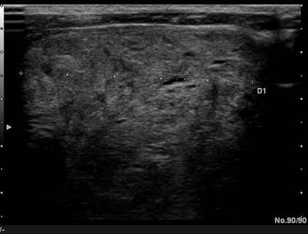 Multinodular Goiter Radiology Case Radiopaedia Org