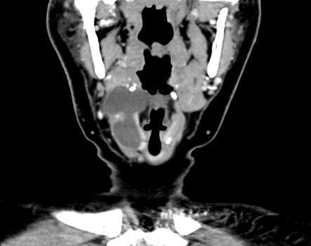 Thyroglossal Duct Cyst Image Radiopaedia Org