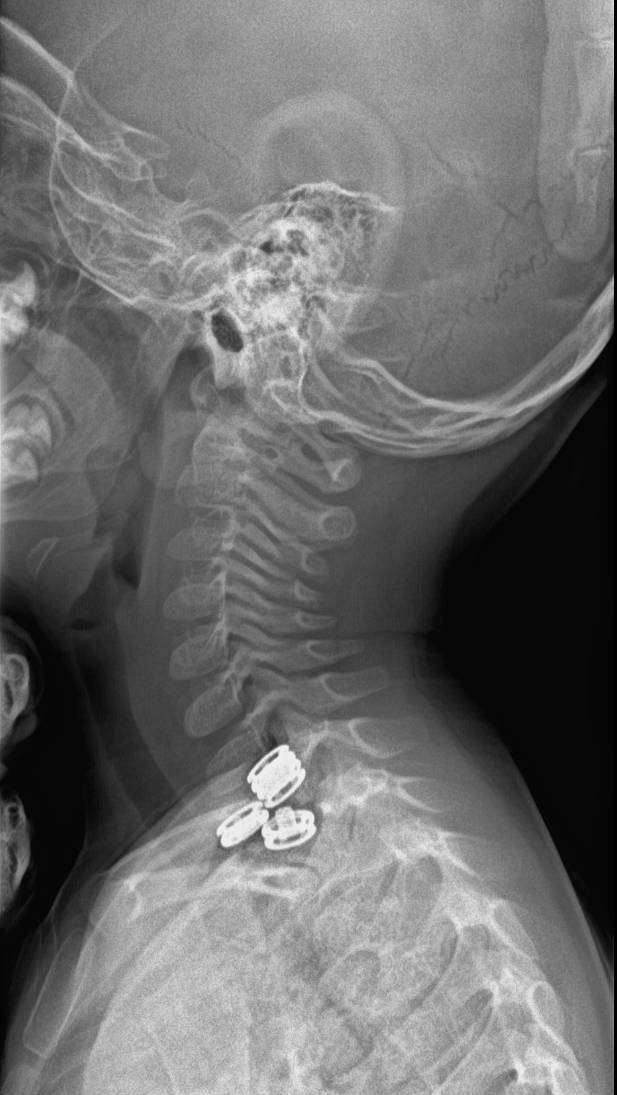 Normal Cervical Spine Radiographs 2 Year Old Image Radiopaedia Org