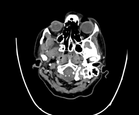 Normal Head Ct Angiogram Image Radiopaedia Org