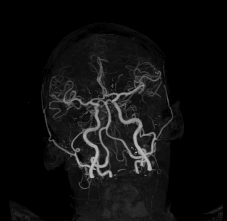 Normal Head CT Angiogram Image Radiopaedia Org