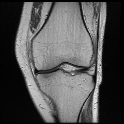 Popliteus Tendon Gout On MRI Image Radiopaedia Org