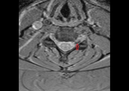 Vertebral Artery Loop Radiology Reference Article Radiopaedia Org