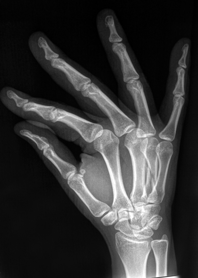 Comminuted Fracture Right Th Metacarpal Image Radiopaedia Org