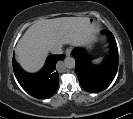 Thoracic Duct Radiology Reference Article Radiopaedia Org