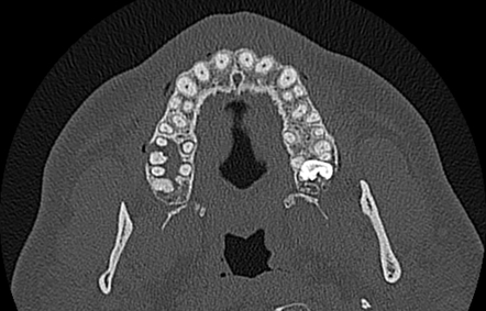 Oro Antral Fistula Image Radiopaedia Org