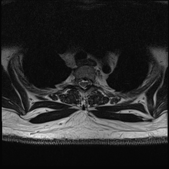 Ossification Of The Posterior Longitudinal Ligament Mixed Type