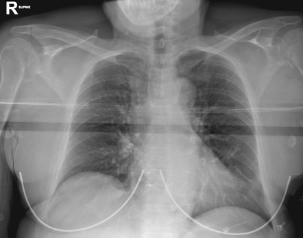 Bilateral Posterior Shoulder Dislocation Radiology Case Radiopaedia Org