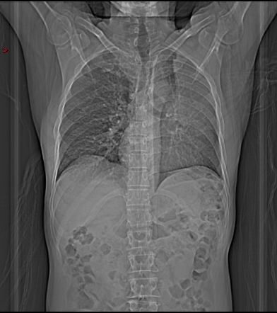 Left Upper Lobe Collapse Due To Lung Cancer Radiology Case Radiopaedia Org