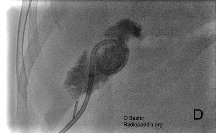 Percutaneous Cholecystostomy Radiology Reference Article