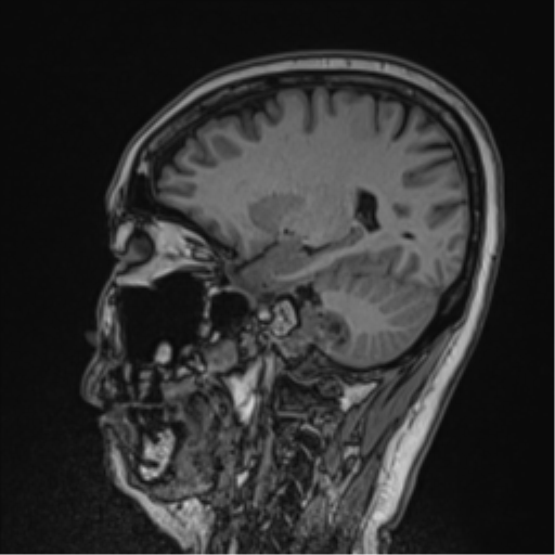 Jugular Foramen Schwannoma With Cystic Degeneration Image