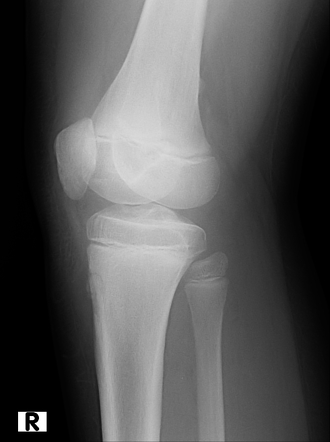 Osgood Schlatter Disease Radiology Case Radiopaedia Org