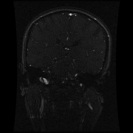 Cavernoma With Developmental Venous Anomaly Image Radiopaedia Org