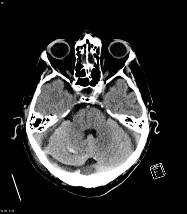 Remote Cerebellar Hemorrhage Radiology Reference Article