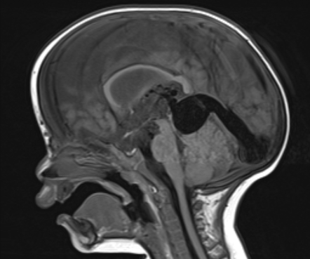 Vein Of Galen Aneurysmal Malformation Image Radiopaedia Org