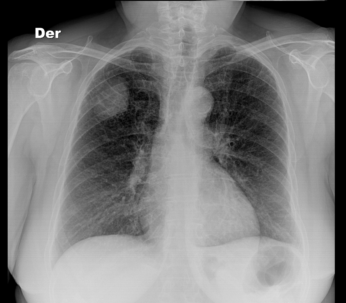 Lung Cancer With Cervical Metastases Image Radiopaedia Org