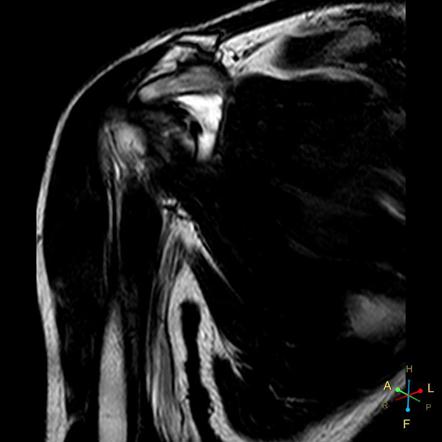 Subcoracoid Impingement With Partial Subscapularis Tendon Tear