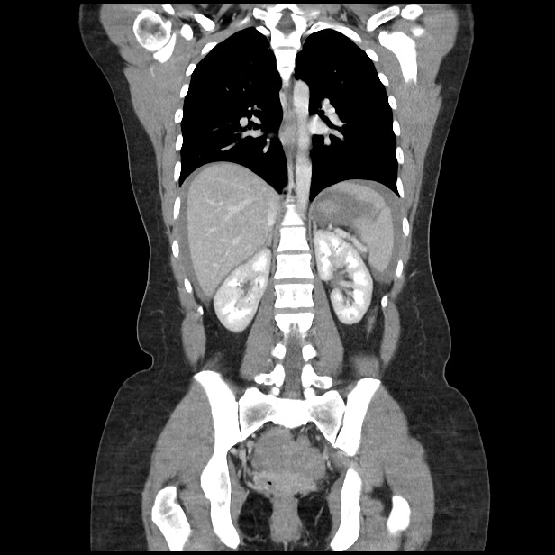 Ruptured Corpus Luteum Cyst Image Radiopaedia Org