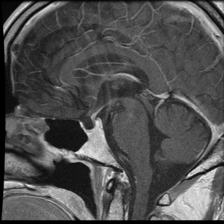 Neurosarcoidosis Pituitary Gland Involvement Image Radiopaedia Org