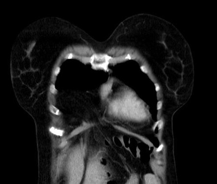 Morgagni Hernia Radiology Case Radiopaedia Org