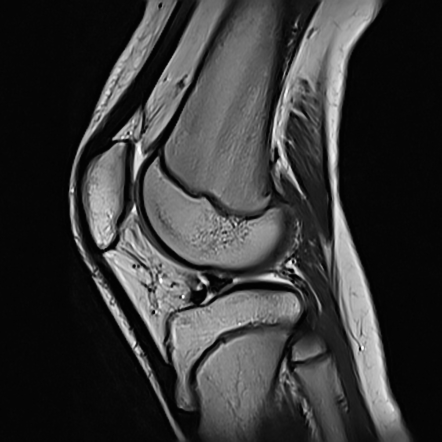 Double Delta Sign Meniscal Tear Radiology Reference Article Radiopaedia Org