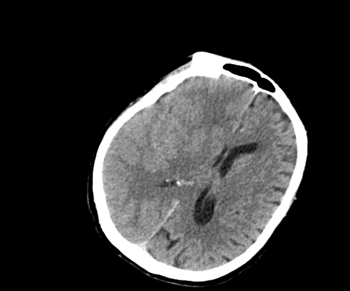 Subacute Subdural Hematoma Image Radiopaedia Org