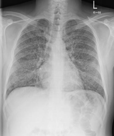 Pulmonary Alveolar Proteinosis Radiology Reference Article Radiopaedia Org