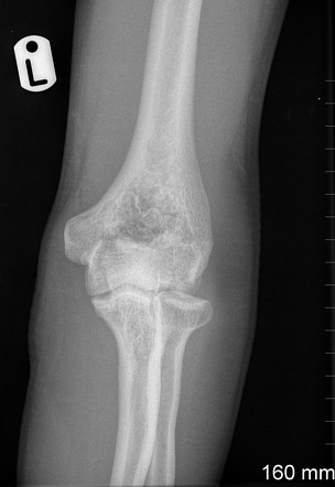 Synovial Chondromatosis Of The Elbow Joint Radiology Case