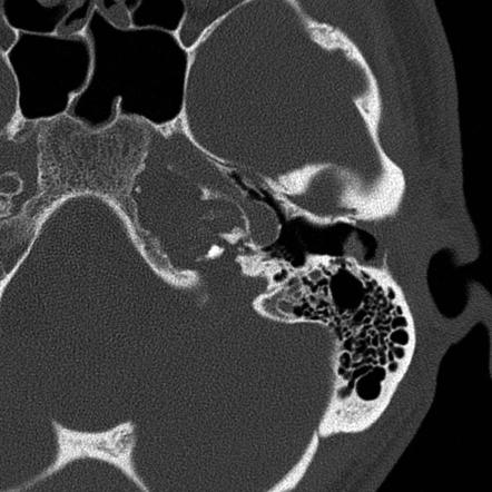 Petrous Apicitis Image Radiopaedia Org