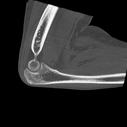 Normal Elbow CT Radiology Case Radiopaedia Org