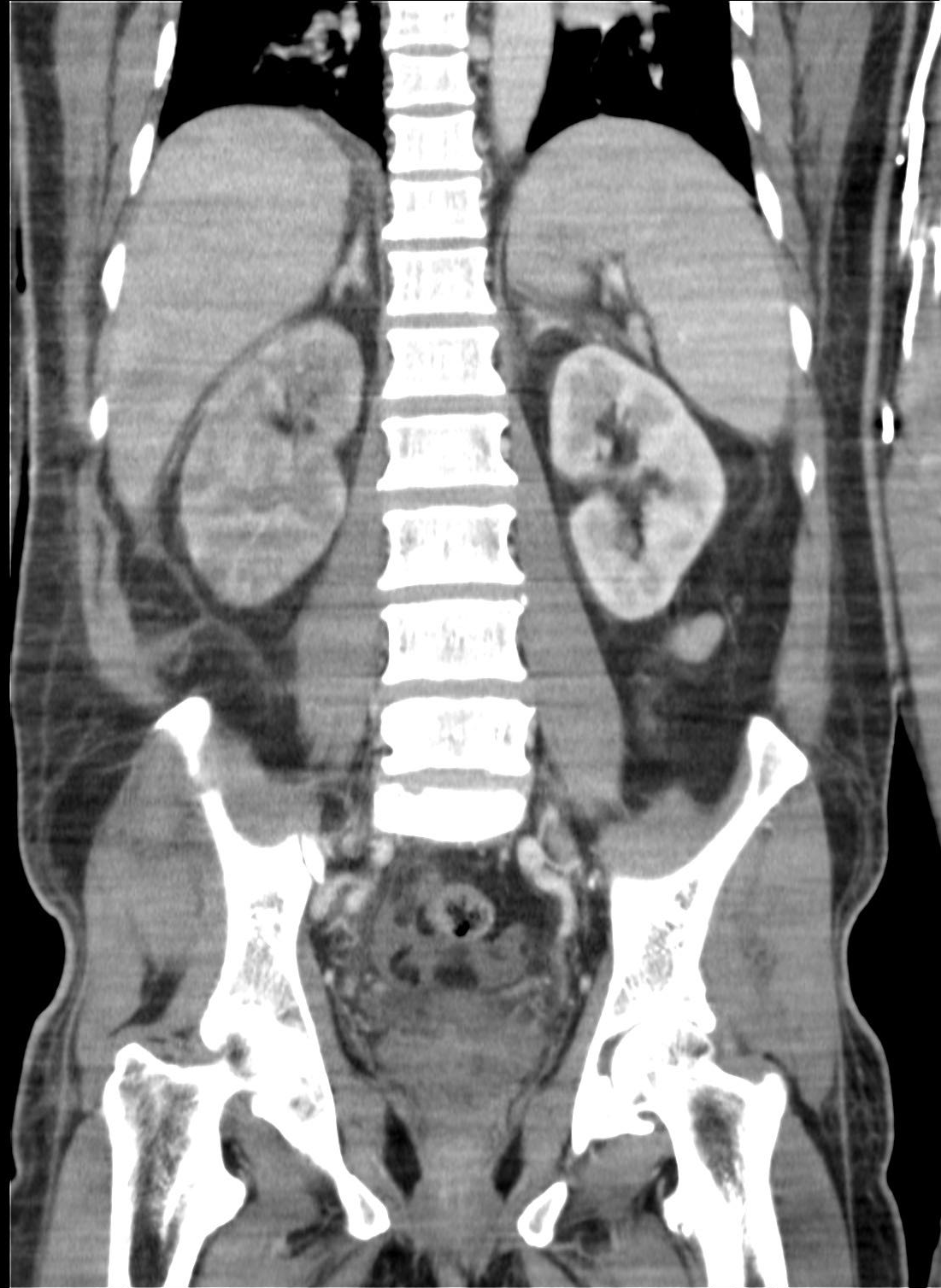 Pyelonephritis Image Radiopaedia Org