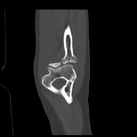 Radial Head Fracture Image Radiopaedia Org