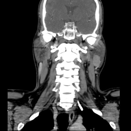 Pleomorphic Adenoma Of The Salivary Glands Radiology Reference