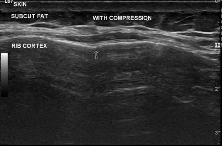 Buckle Rib Fracture Radiology Case Radiopaedia Org