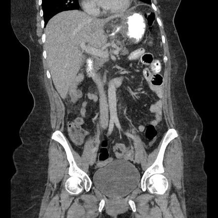 Leak From Stomach After Removal Of Gastric Band Due To Erosion